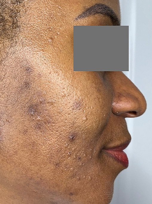 Facials Before & After