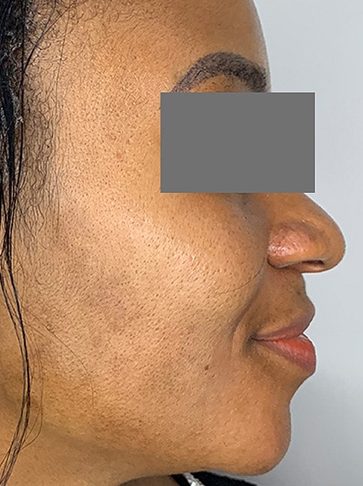 Facials Before & After