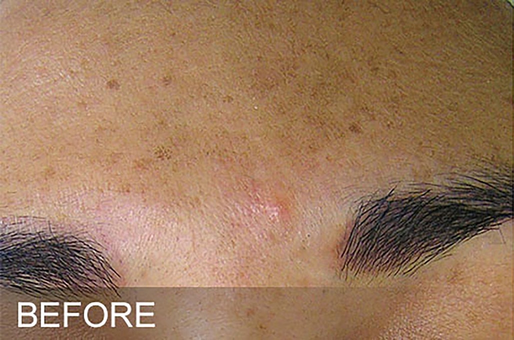 Hydrafacial Before & After