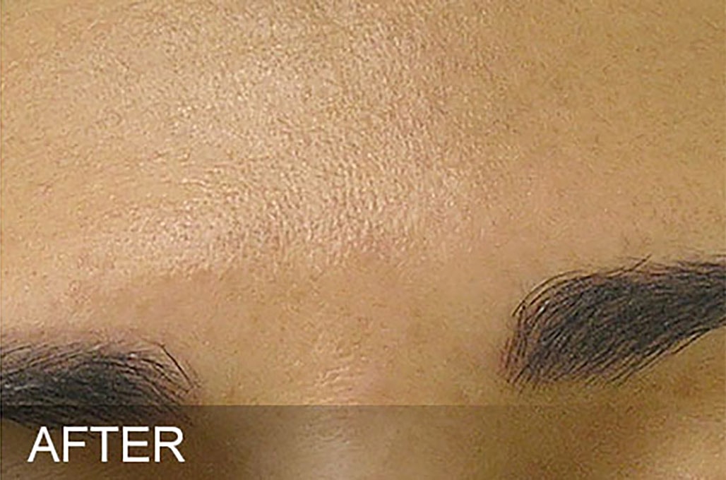Hydrafacial Before & After