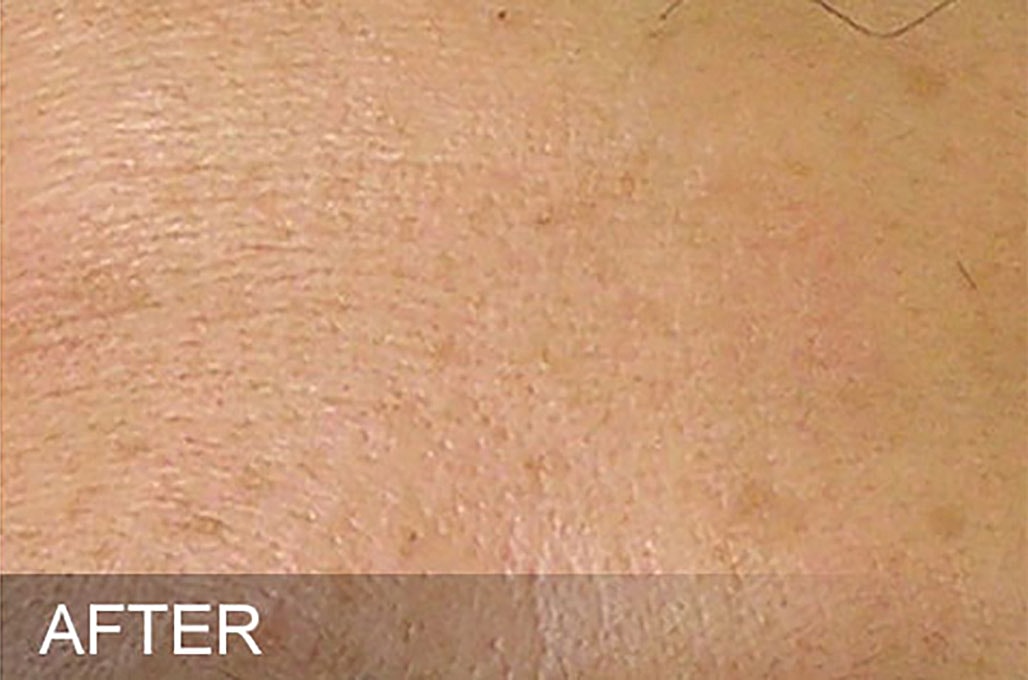 Hydrafacial Before & After