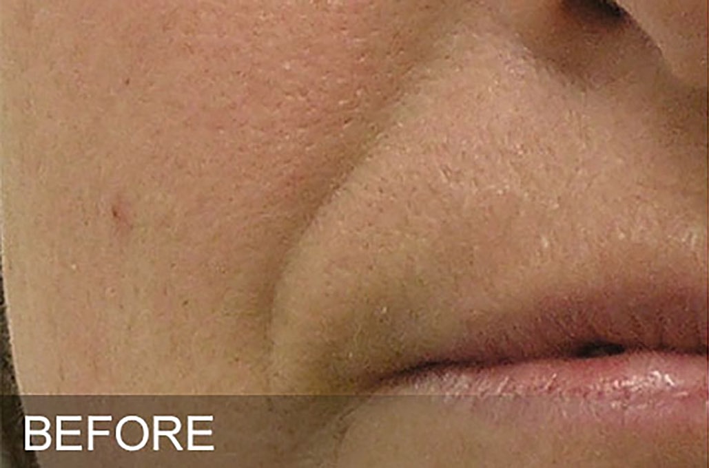 Hydrafacial Before & After