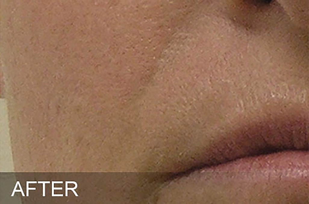 Hydrafacial Before & After