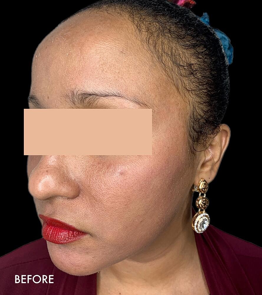 Hydrafacial Before & After