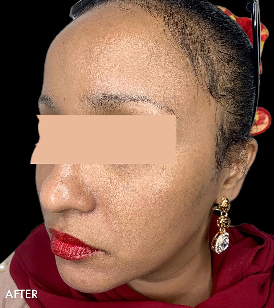 Hydrafacial Before & After