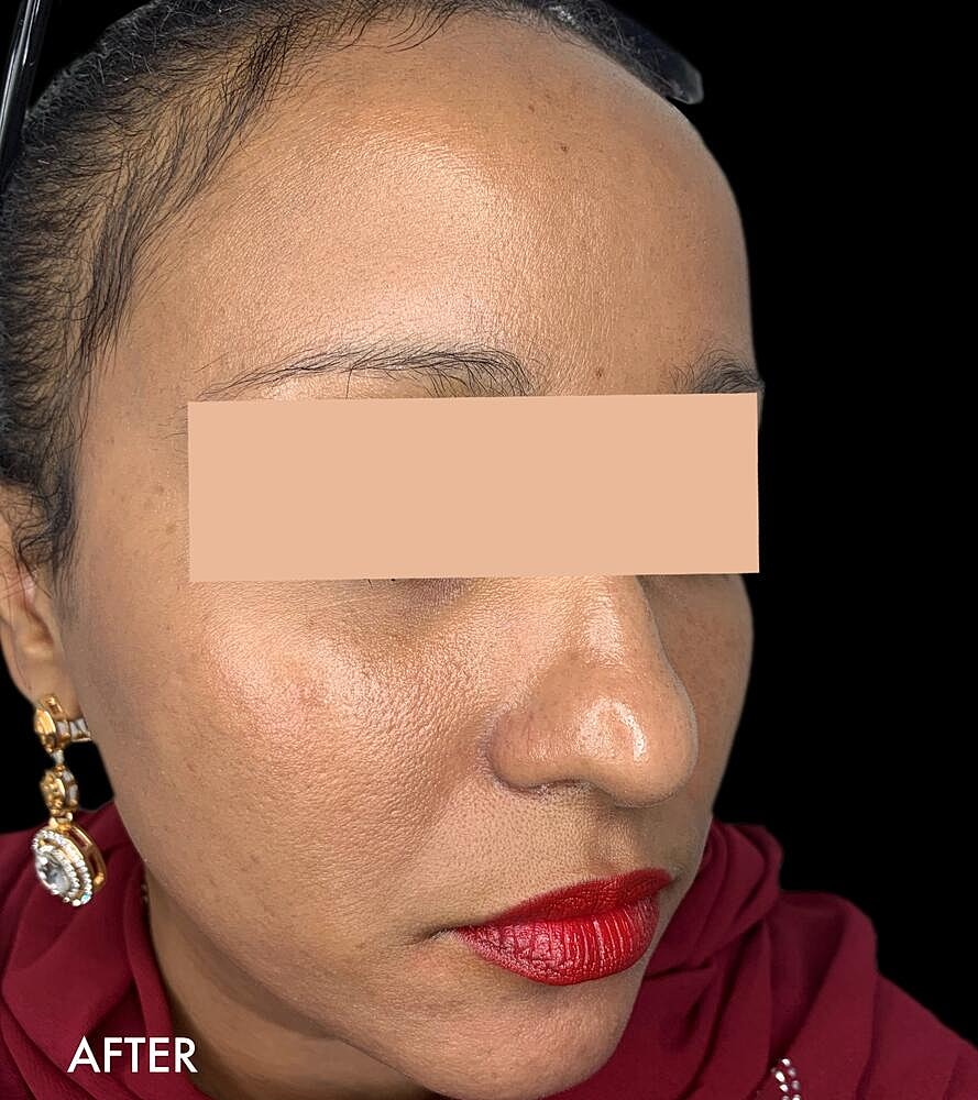 Hydrafacial Before & After