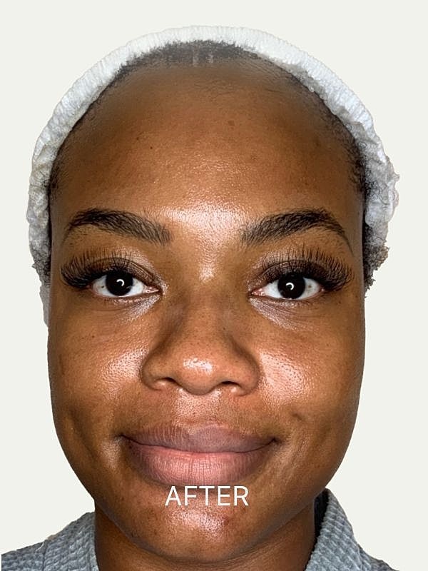 Skincare treatment results, showing glowing skin.