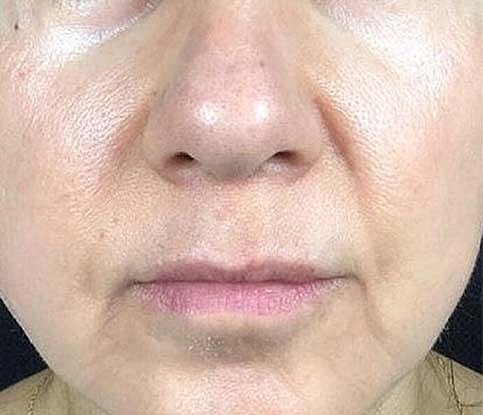 Laser Skin Treatments Before & After