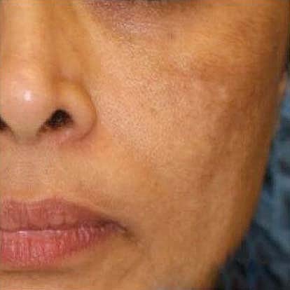 Laser Skin Treatments Before & After