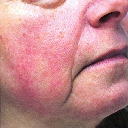 Laser Skin Treatments Before & After