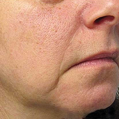 Laser Skin Treatments Before & After