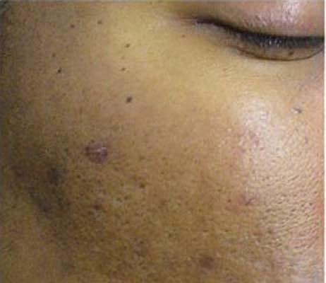 Laser Skin Treatments Before & After