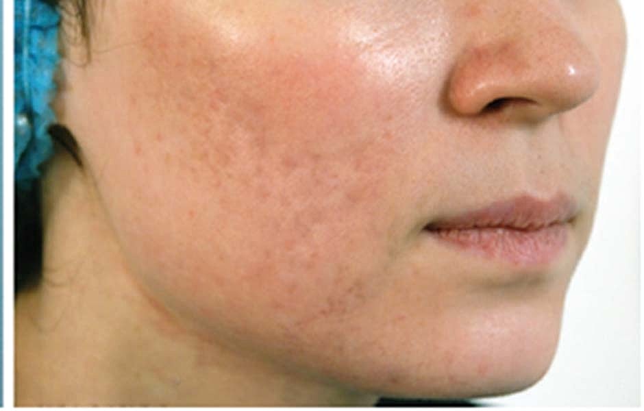Laser Skin Treatments Before & After