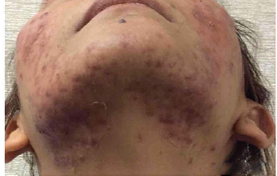 Laser Skin Treatments Before & After