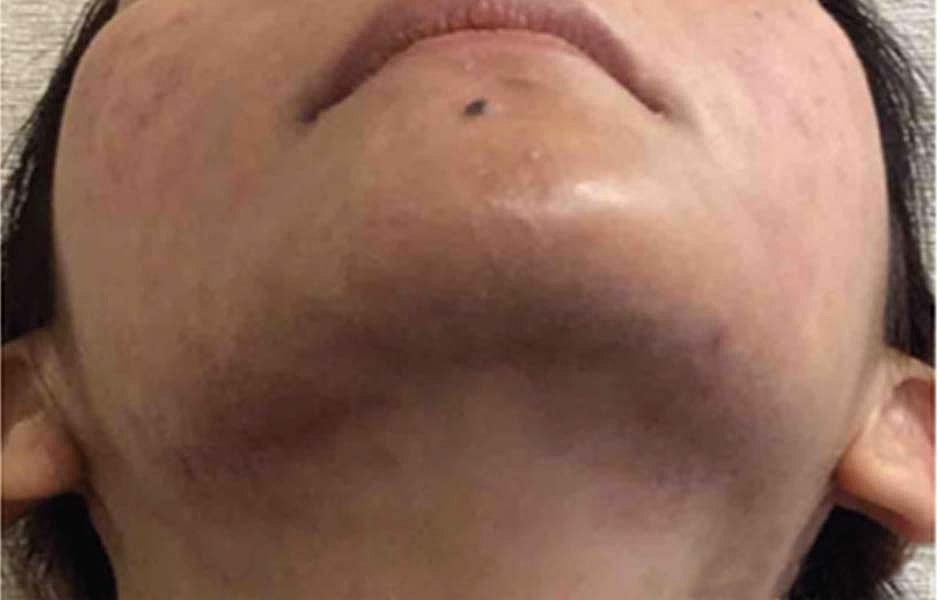 Laser Skin Treatments Before & After