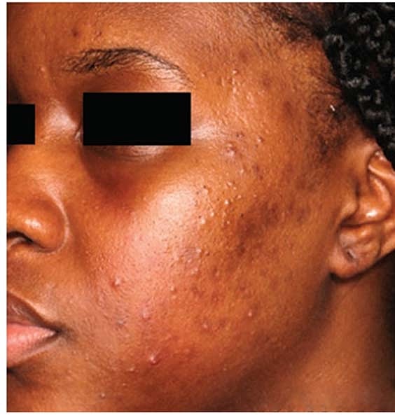 Laser Skin Treatments Before & After
