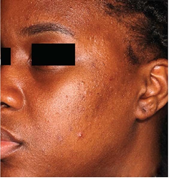 Laser Skin Treatments Before & After