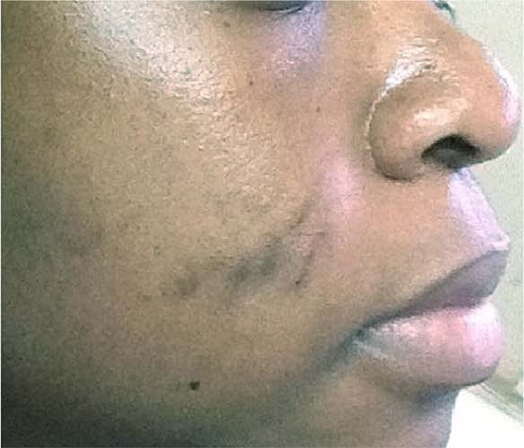 Laser Skin Treatments Before & After