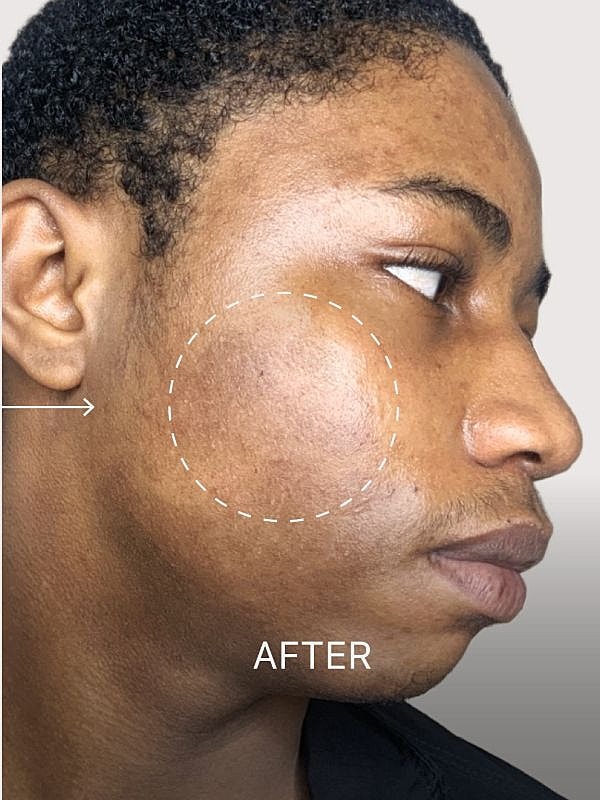 Skin improvement before and after treatment.