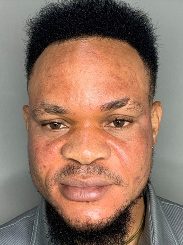 Smile Lines And Nasolabial Fold Fillers Before & After