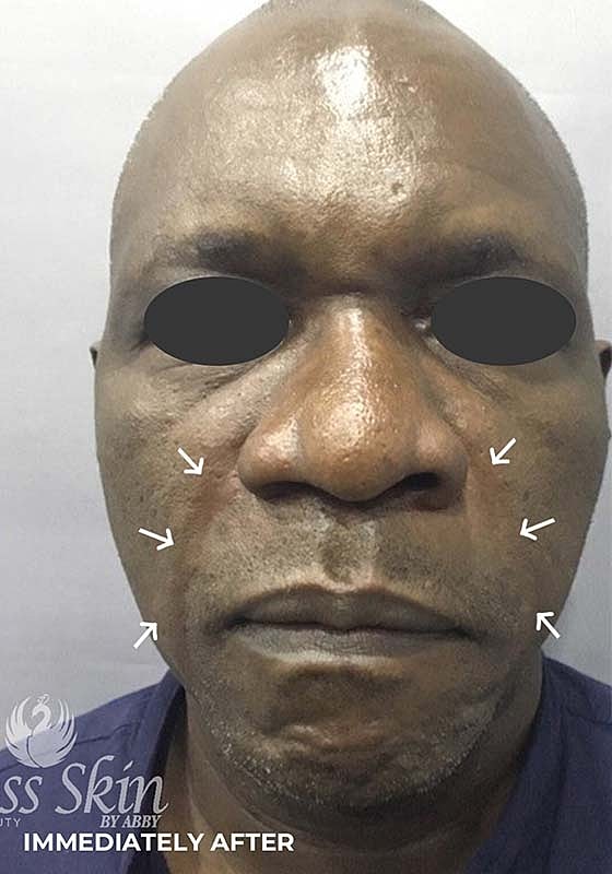 Smile Lines And Nasolabial Fold Fillers Before & After