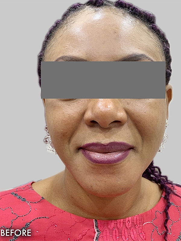 Smile Lines And Nasolabial Fold Fillers Before & After