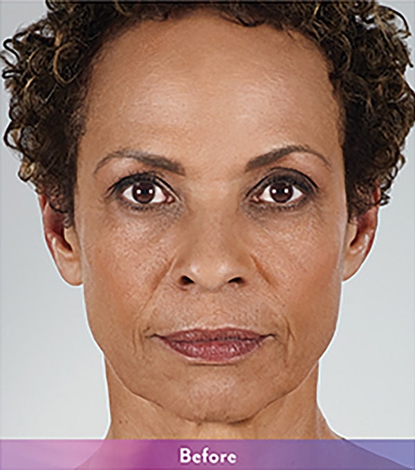 Smile Lines And Nasolabial Fold Fillers Before & After