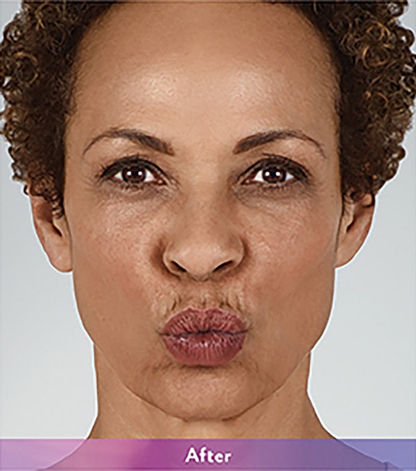 Smile Lines And Nasolabial Fold Fillers Before & After