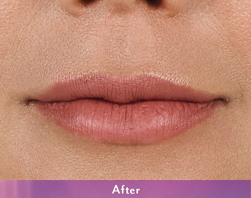 Smile Lines And Nasolabial Fold Fillers Before & After
