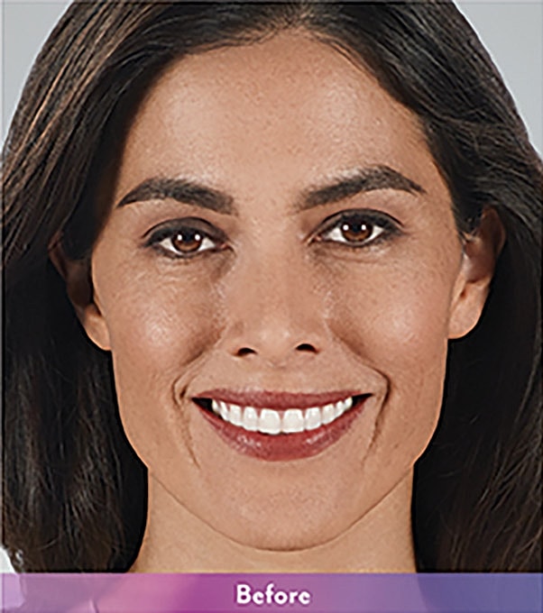 Smile Lines And Nasolabial Fold Fillers Before & After