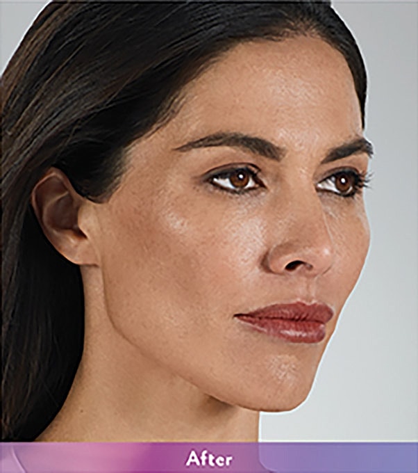 Smile Lines And Nasolabial Fold Fillers Before & After