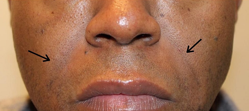 Smile Lines And Nasolabial Fold Fillers Before & After