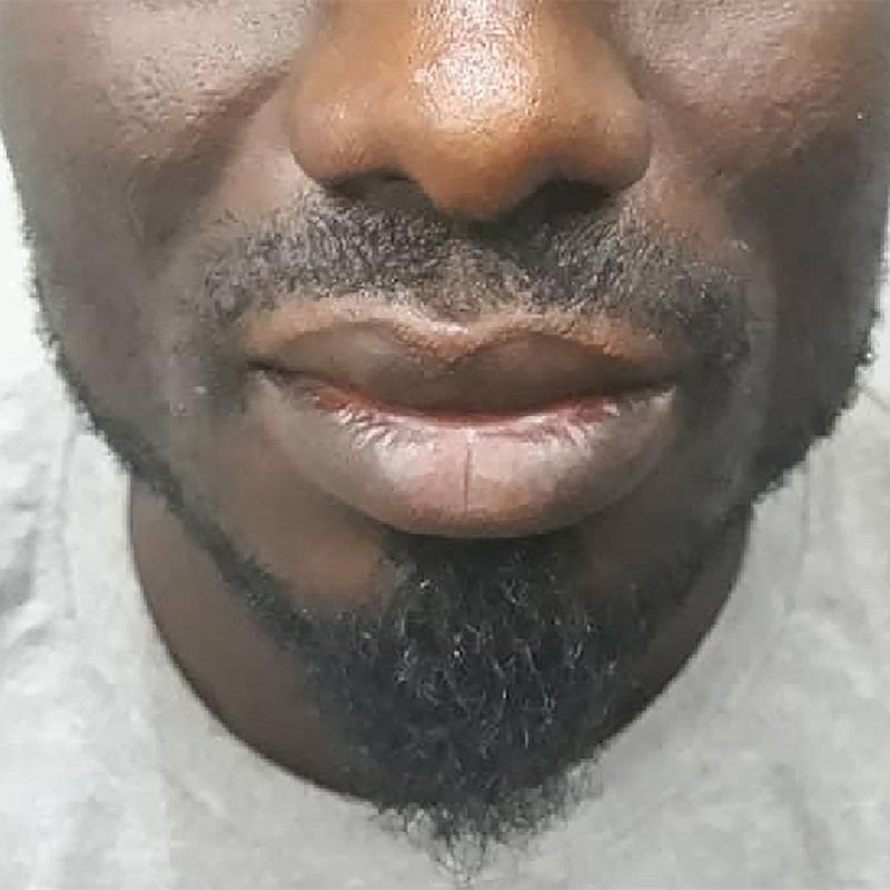 Smile Lines And Nasolabial Fold Fillers Before & After