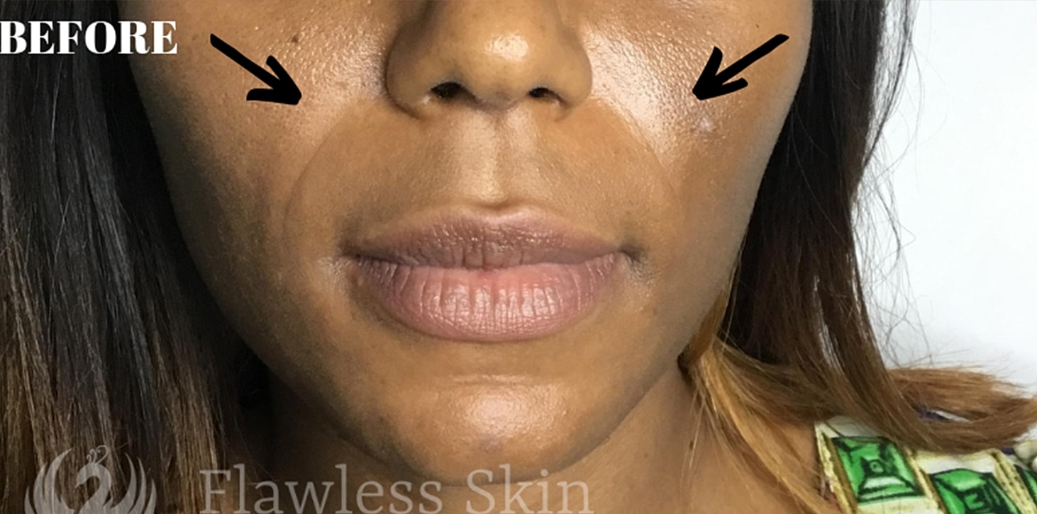 Smile Lines And Nasolabial Fold Fillers Before & After