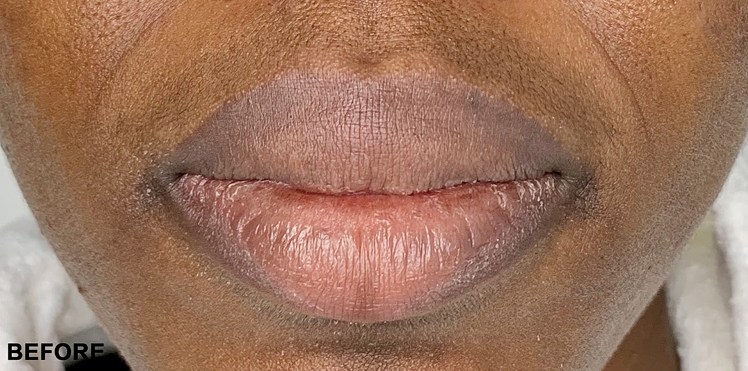 Smile Lines And Nasolabial Fold Fillers Before & After