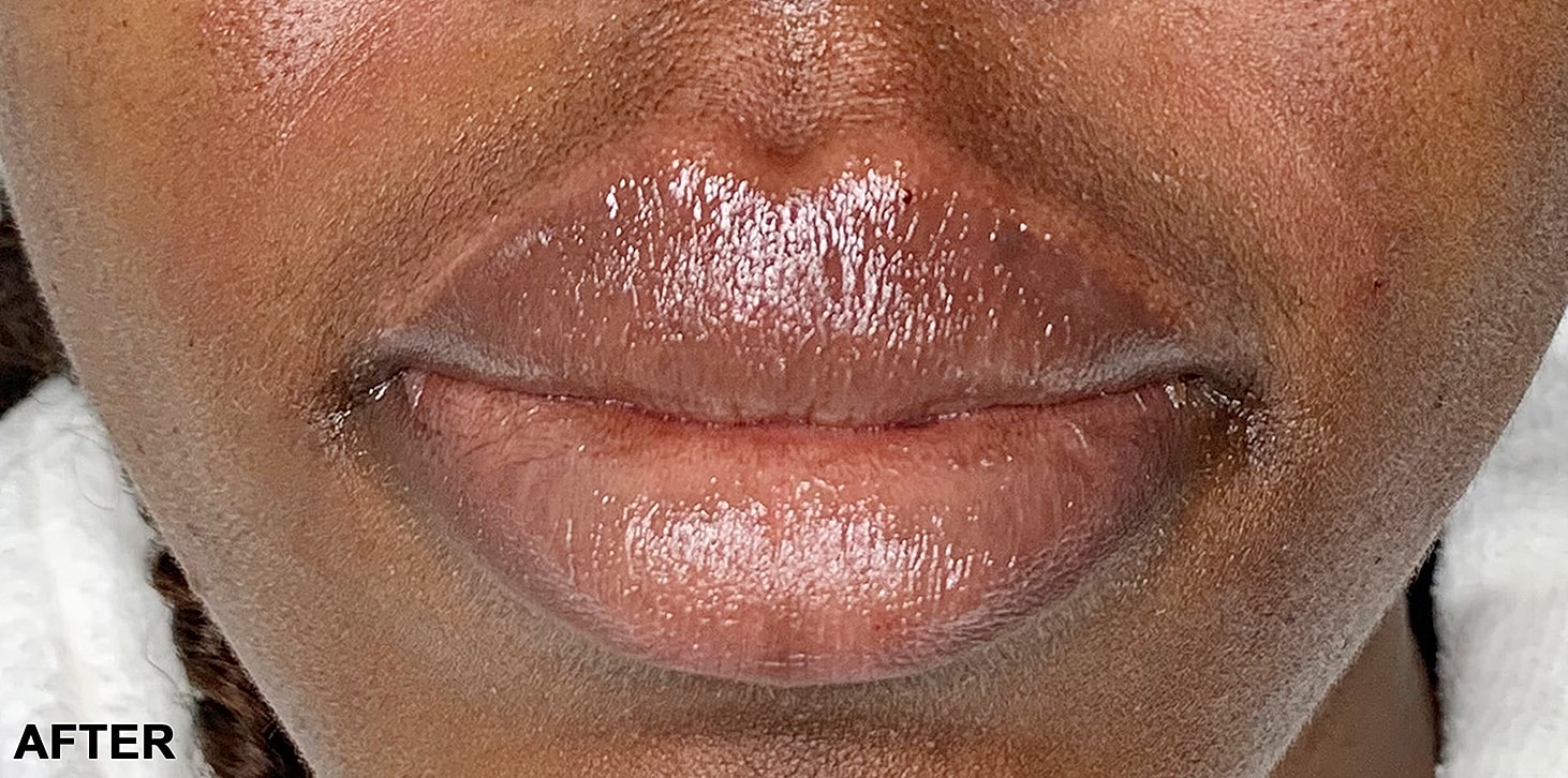 Smile Lines And Nasolabial Fold Fillers Before & After