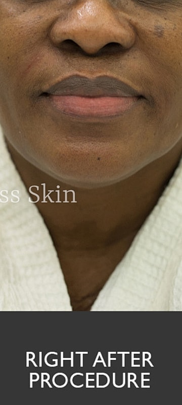 Smile Lines And Nasolabial Fold Fillers Before & After