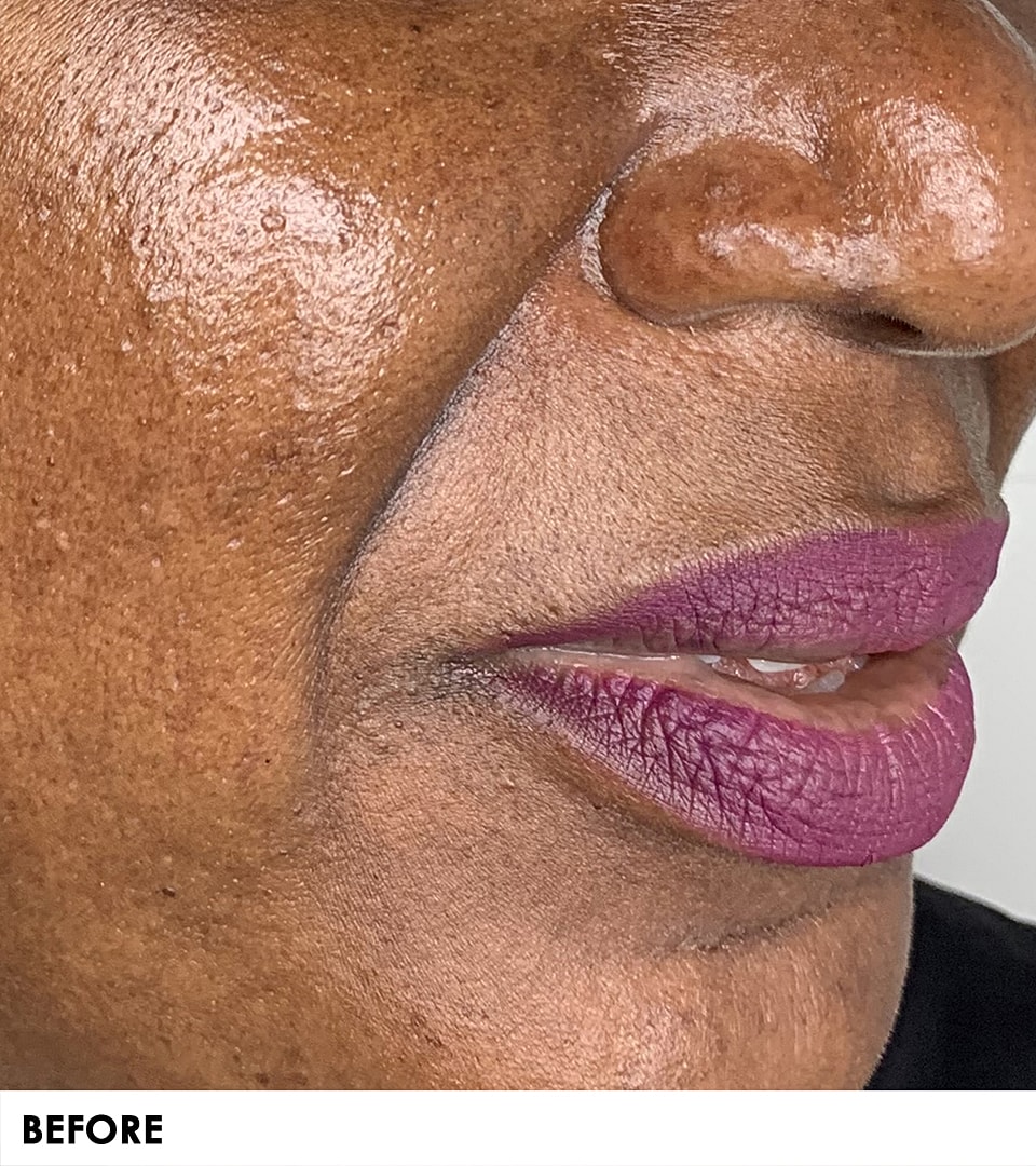 Smile Lines And Nasolabial Fold Fillers Before & After