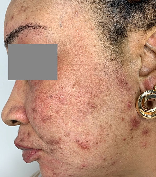 Chemical Peels Before & After