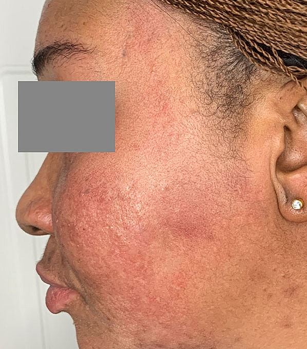 Chemical Peels Before & After