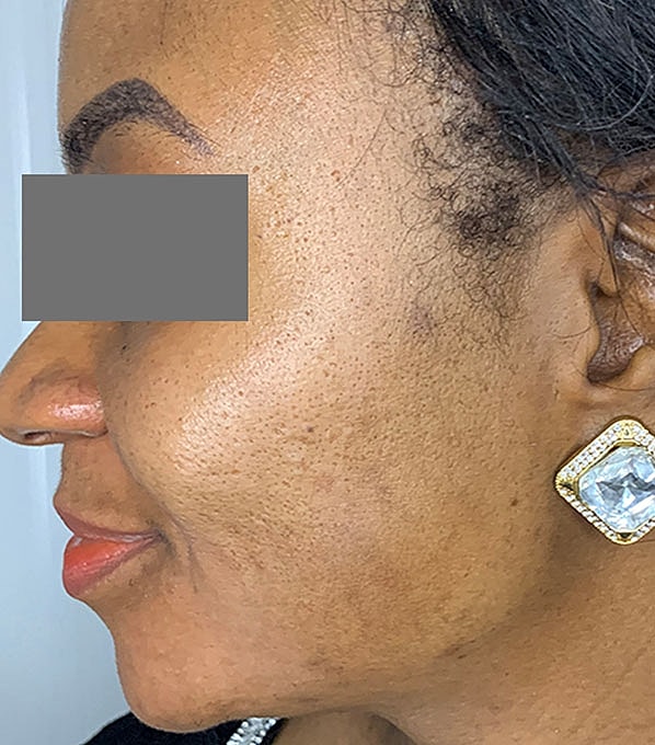 Chemical Peels Before & After