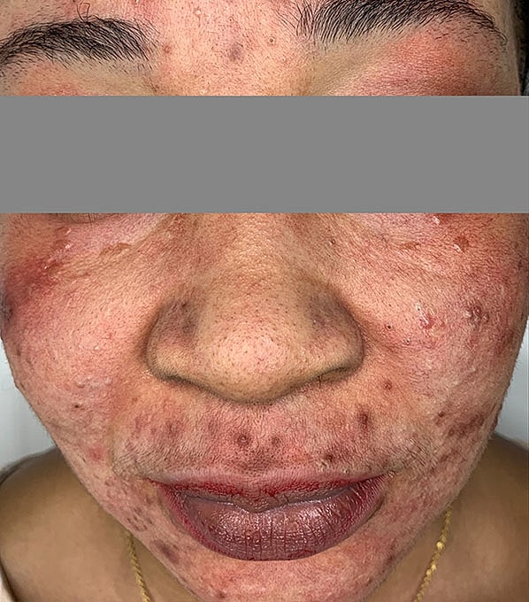 Chemical Peels Before & After