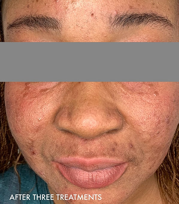 Chemical Peels Before & After