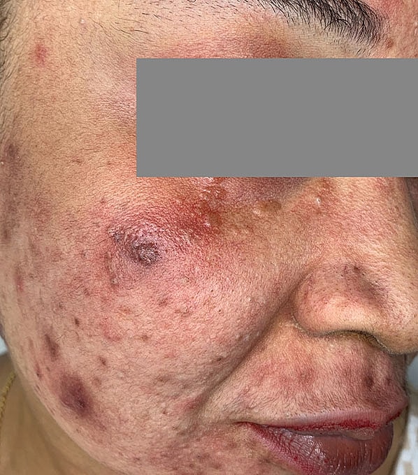 Chemical Peels Before & After