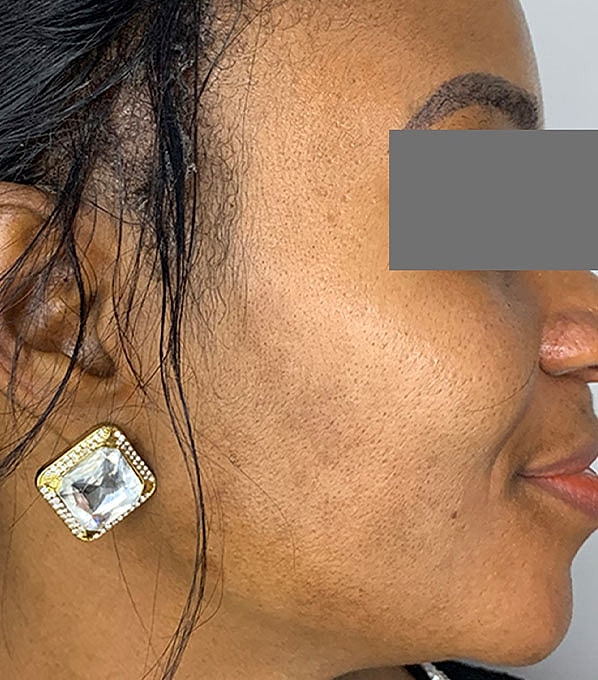 Chemical Peels Before & After