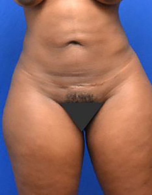 Liposuction Before & After