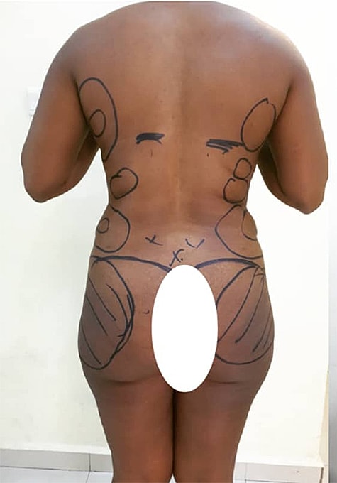 Liposuction Before & After