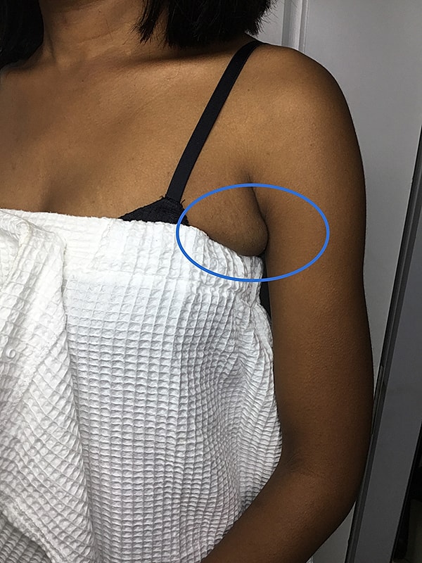 Liposuction Before & After