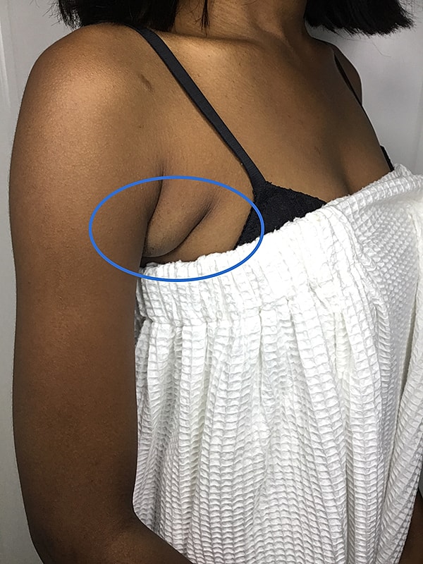 Liposuction Before & After