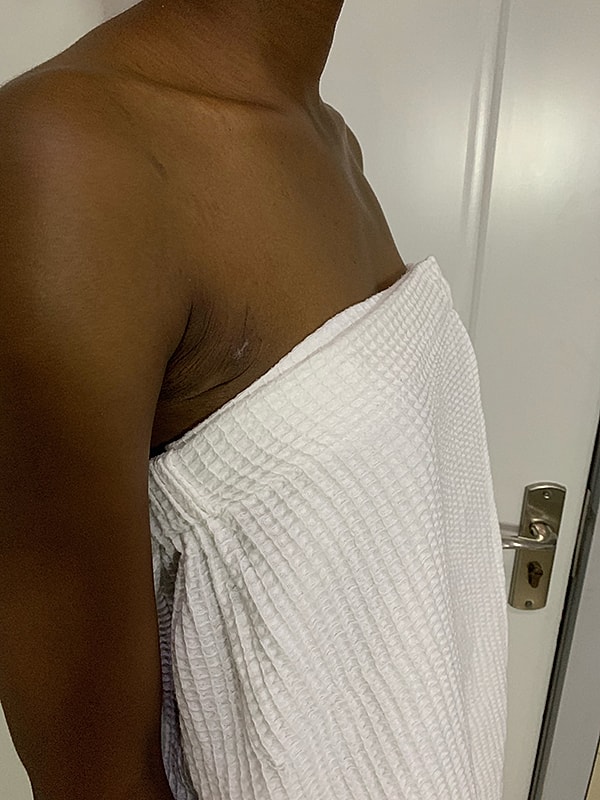 Liposuction Before & After